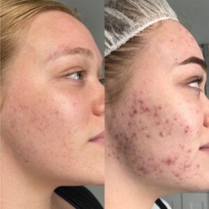 Dermalux Treatment for Acne