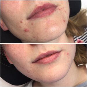 Before and after results of acne treatment with Dermalux LED therapy