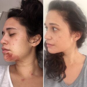 Before and after skin recovery following Dermalux LED treatment