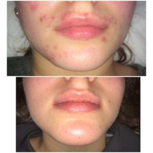 Before and after results of acne treatment on spot-prone skin