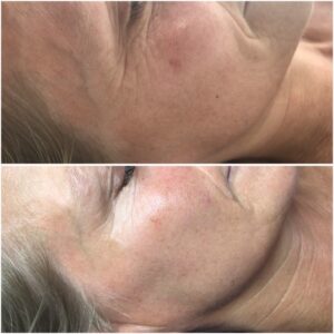 Skin Rejuvenation with Dermalux