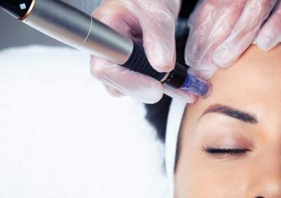 Microneedling Treatments Surrey